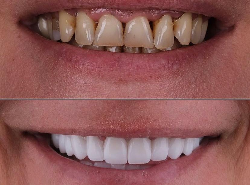 Dents usées facettes E-max Avant Après