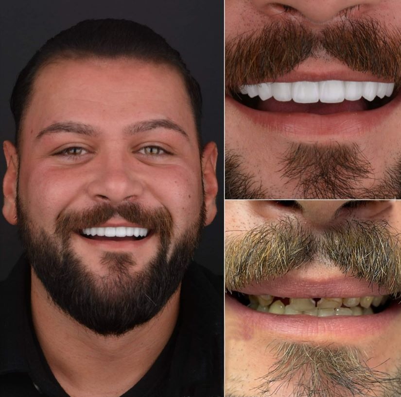Pertes de dents multiples implants Avant Après