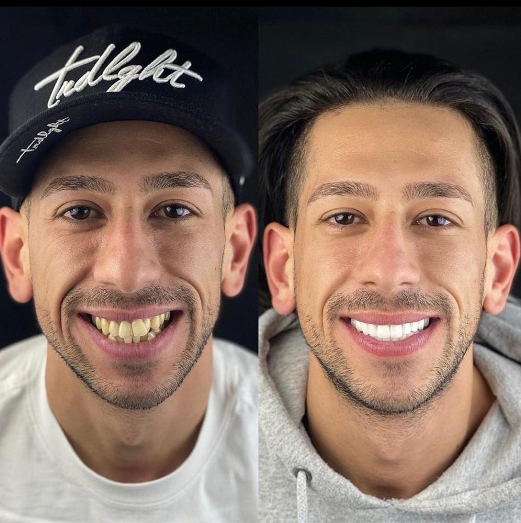 Dents chevauchées Hollywood Smile Avant Après