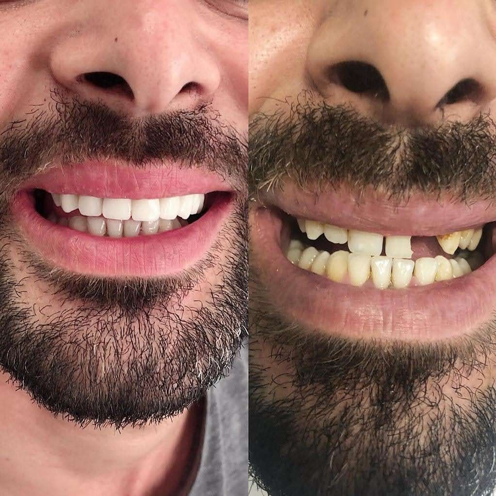 Implant unitaire Avant Après