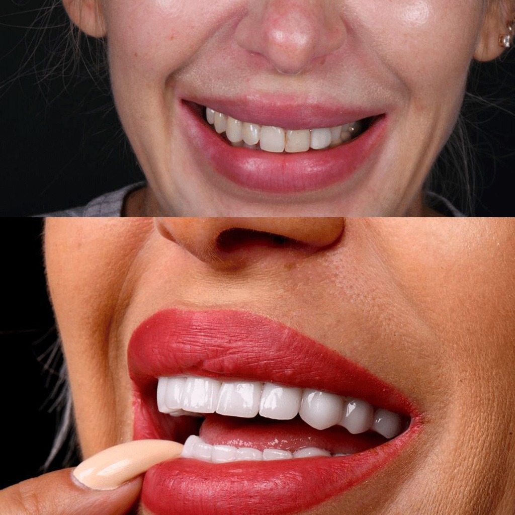 Dents tachées facettes porcelaine Avant Après