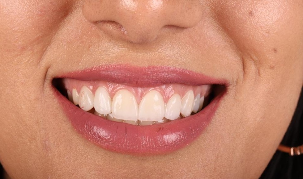 Après Hollywood Smile