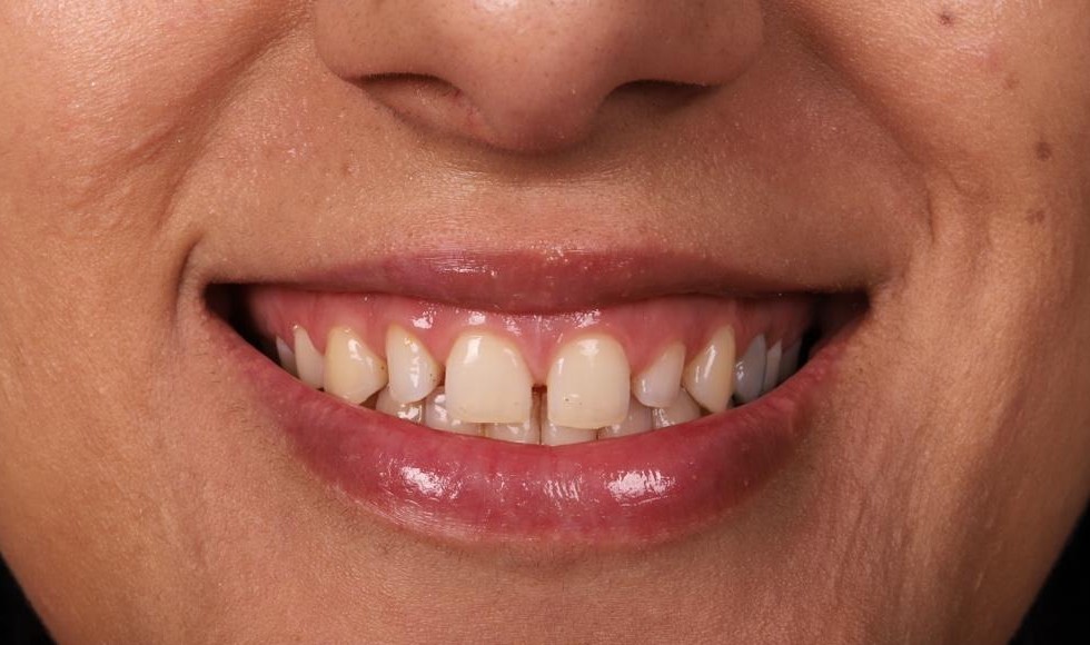Dents Avant Le Traitement